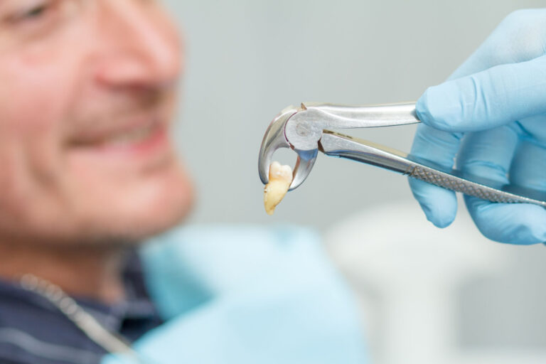 fa male togliere il dente del giudizio
